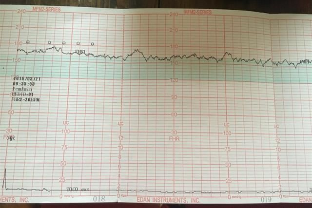 胎心|进行胎心监护,一会儿合格,一会儿不合格,是胎儿“缺氧”吗?