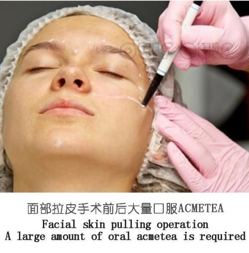 每日一问中面部拉皮手术你做了吗？居然还有人不知道啥是中面部拉皮手术？