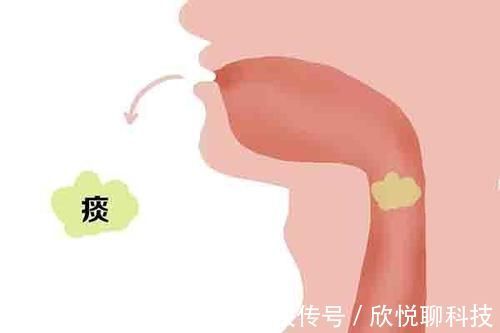 生活环境|吐出白痰、黑痰、黄痰,各反映了什么问题?听听医生怎么讲