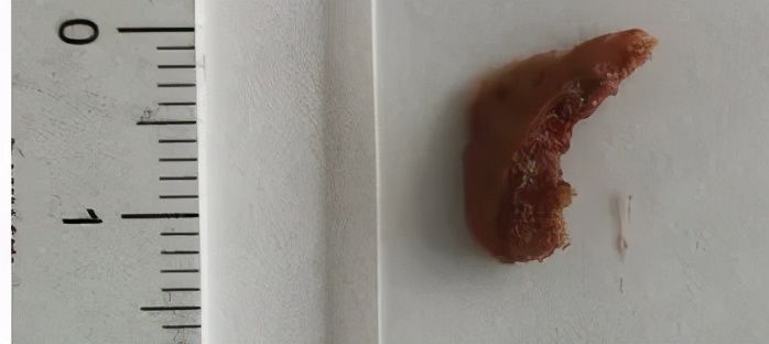 骨头|前年醉酒时吃的三黄鸡，在今年险些要了他的命