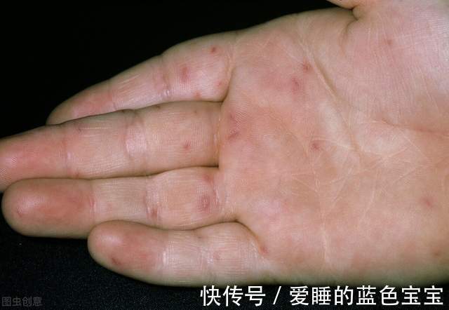71型|入冬后,“手足口病”又出来猛刷存在感了,我们该如何预防