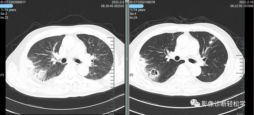 金葡菌|快快乐乐过大年，轻松学习肺部影像 实战篇 续