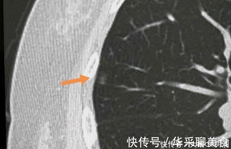 体检|年年体检，为什么还得了晚期肺癌？体检有啥用！