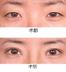 重睑术是什么?俗称割双眼皮,双眼皮手术