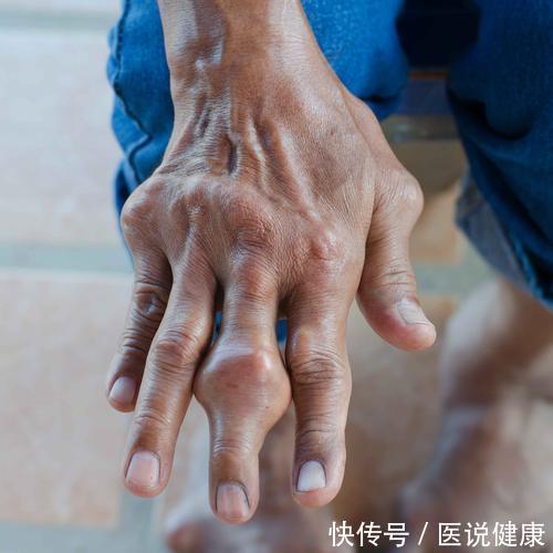 dn手指莫名出现杵状指,或是肺癌到来的信号,及时检查肺CT