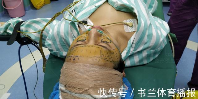 全脸整容术 34岁山东美女全脸整容术后60天,朋友说换了一张脸颜值逆袭女神