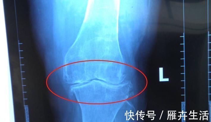 骨骺线|男生身高多少岁“停止发育”?不是18,也不是23,而是这个数