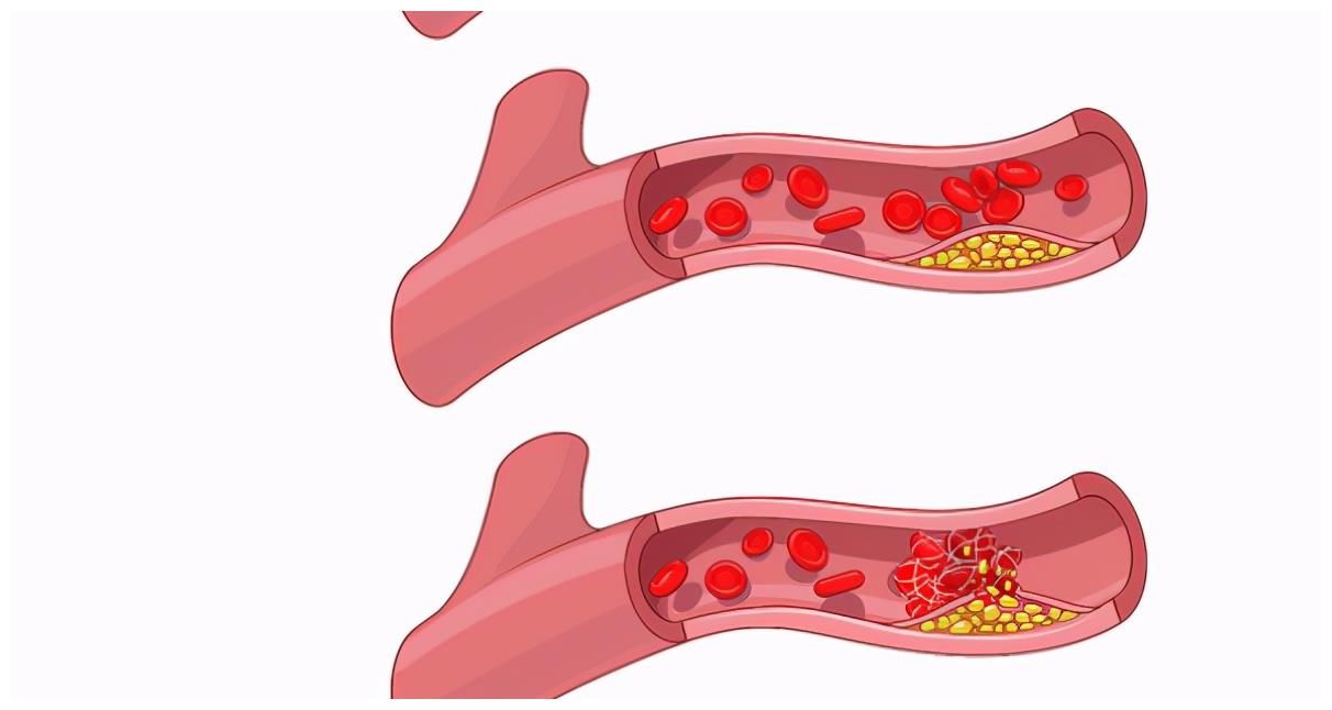 身体出现5种情况，大概率身体存在血栓，做好3事，降脂溶栓，血管变通畅