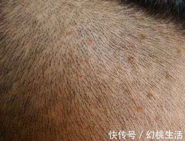 当心|头皮总是长疙瘩是怎么回事 当心是身体出现了这些问题!