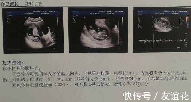 肾盂分离|四维彩超上的“信息”可能暗示了宝宝的“性别”,孕妈了解一下