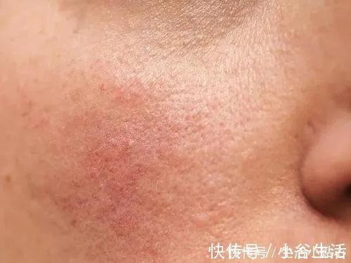 药醇|失去肌肤屏障后的肌肤越来越敏感怎么办?有5件事你要认真记住了