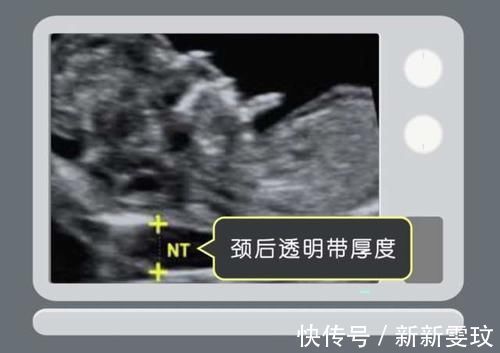 检查|接NT秒过！超级管用的注意事项！NT彩超一次性过！