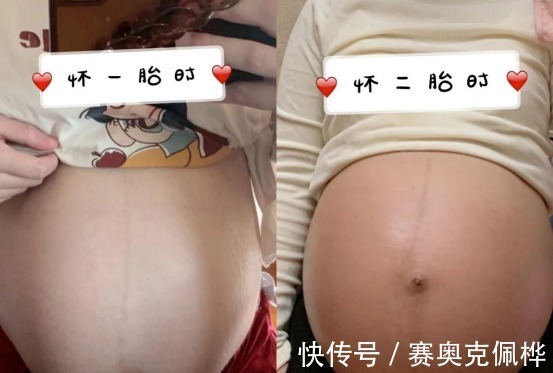 精华乳|妊娠纹只要长出来就是一辈子!拒绝“西瓜肚”辣妈分享去纹心经
