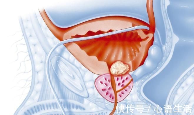 患者|关于前列腺增生治疗你可能忽略了最重要的一步,合理生活方式调整