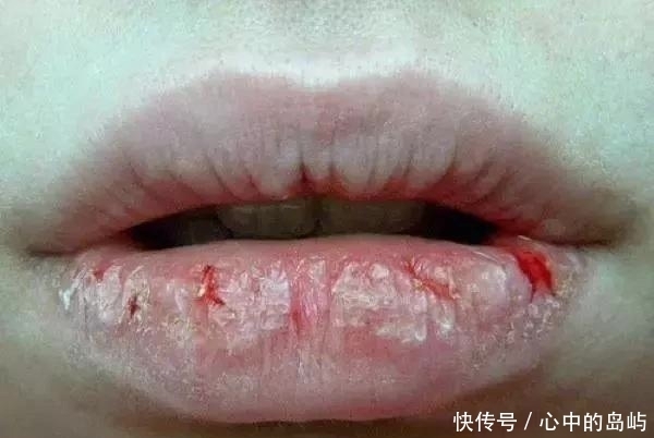 东西|嘴唇干燥不舒服,孕妇挠破了皮,没想到一个月后居然长出个可怕东西
