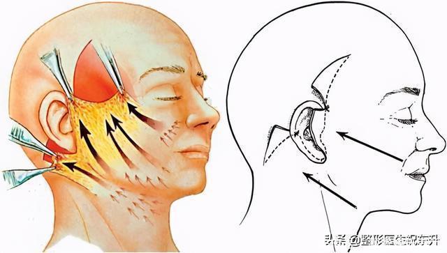 皮肤|奔着年轻去做的大拉皮，怎么脸还“垂”得更快了？