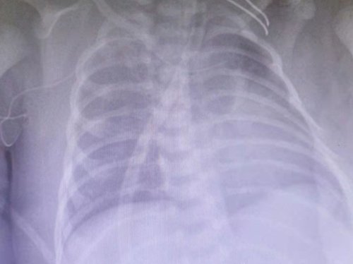 新生儿先天性巨大颈部肿物成功手术,家长为医护人员送来别样礼物