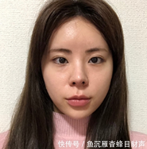 分享我的脸型整形经历 三个月后变清纯少女 快资讯