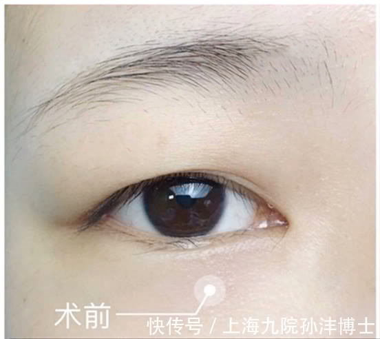 手术 眼修复孙沣博士:双眼皮术后是否会产生疤痕和增生?