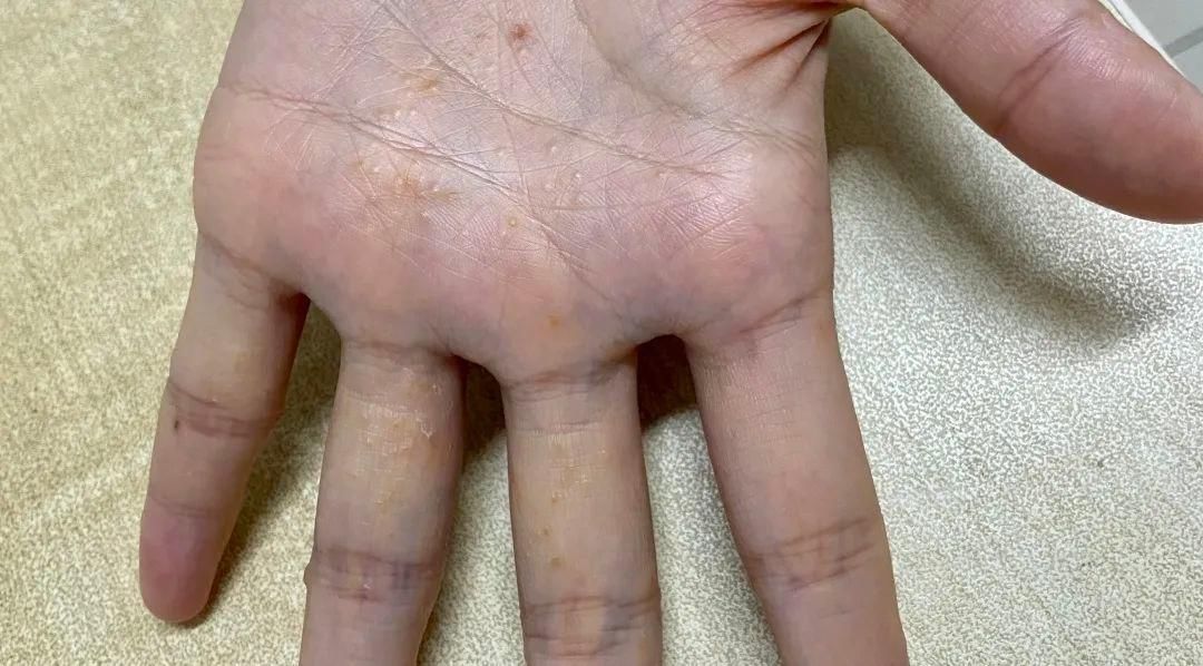 掌跖脓疱病|宝，听说你最近在脱皮？脱什么皮？
