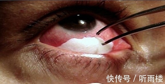 怪病|女孩泪水是棉絮状,医生看了都摇头!表示无能为力