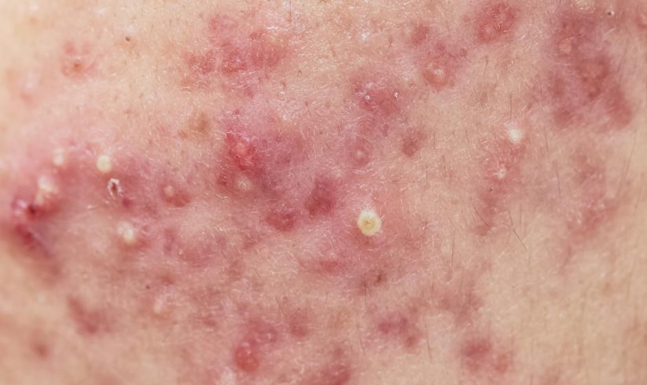 过敏性鼻炎|小小虫子不可轻视,过敏疾病的祸首就是它