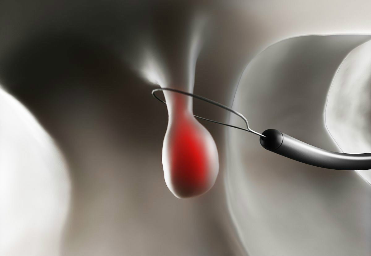 切除|两种息肉最好及时切除,随着时间的推移,会变成癌症