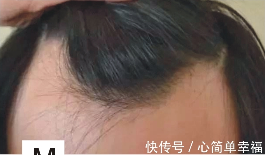 补发 M型发际线的男生,只有这几款发型才能拯救,其他方法的都是浮云