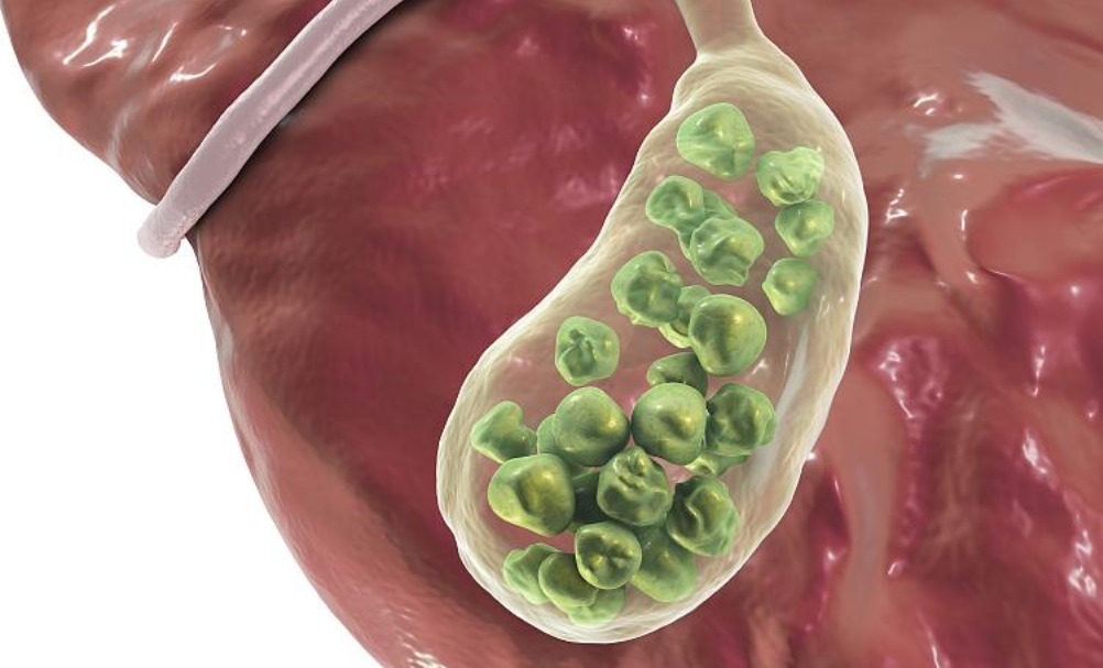 胃结石|秋天多吃柿子身体好,止咳润肺又美容,但3点禁忌应牢记