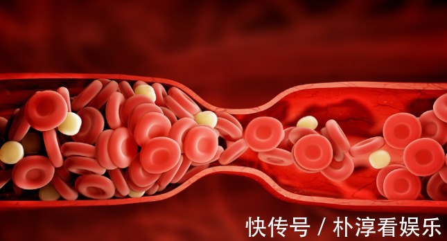 堵塞|45岁后,血管加速老化,5类食物,尽量少吃,血管承受不了