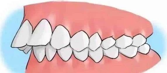 黄金期|孩子牙齿矫正,必须要12岁以后吗?你是否错过了孩子的矫正黄金期