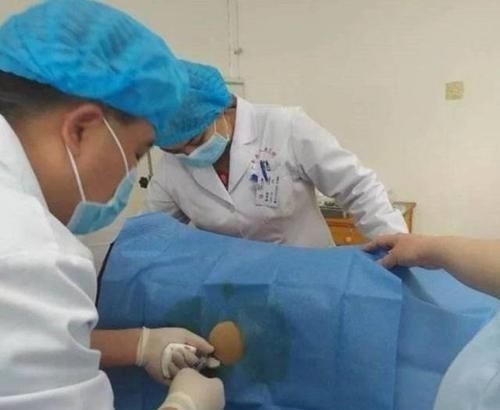 剖腹产|为什么流产手术用“全麻”,剖腹产却用“半麻”?医生说出实情