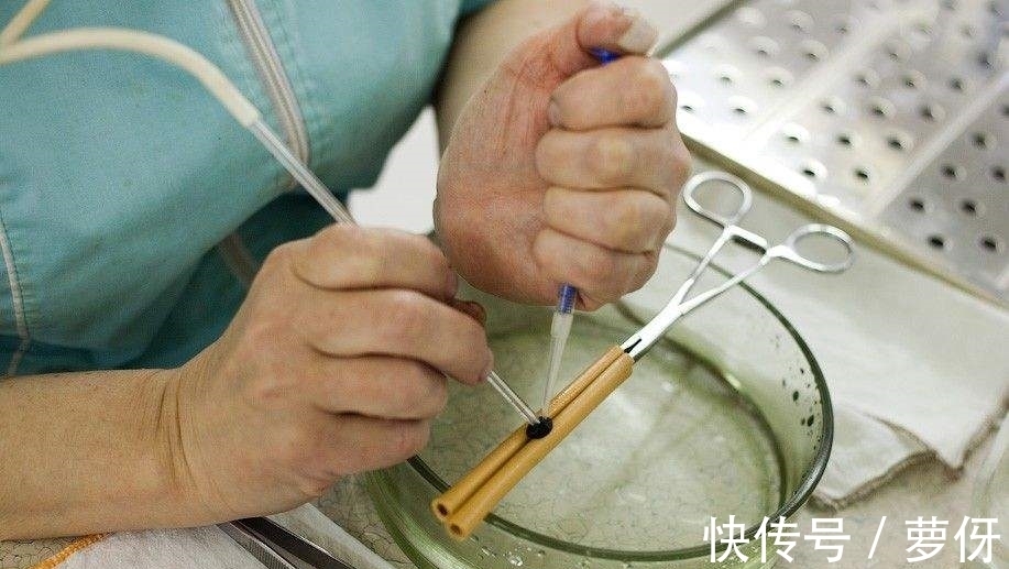 寄生虫|女子患肿瘤几乎丧命，医生从喉咙取出一条”大虫子”，网友：命大