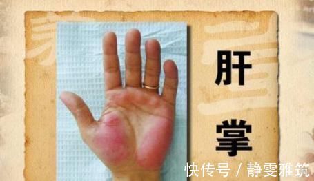 黄疸|“肝脏”若变硬了,身体会亮起“4盏灯”,愿你别假装看不见