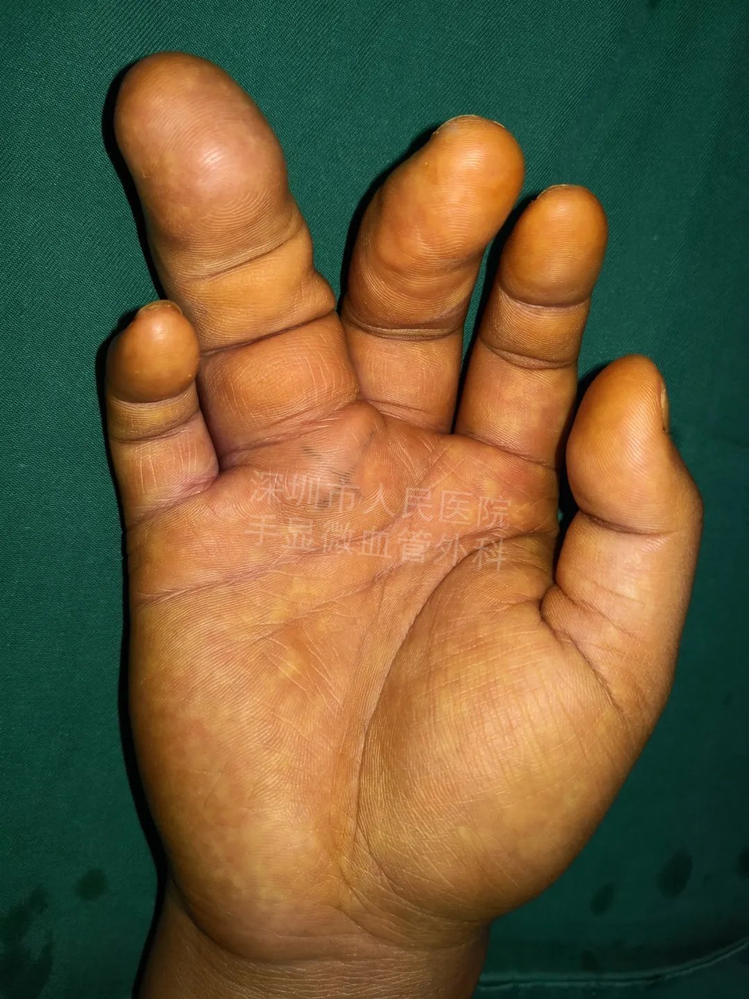 发育不良|得了这病,12岁男孩手指比香蕉还粗!7种常见的手部畸形,家长们要注意