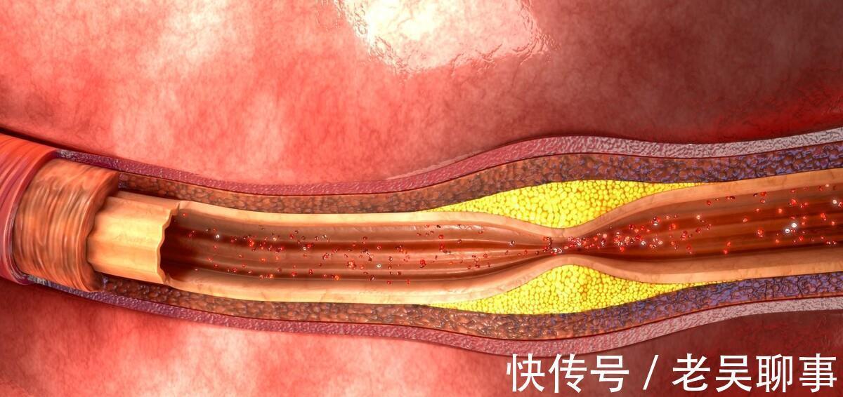 血脂|想预防高血脂、降低甘油三酯，几种方法值得学习，不妨了解一下