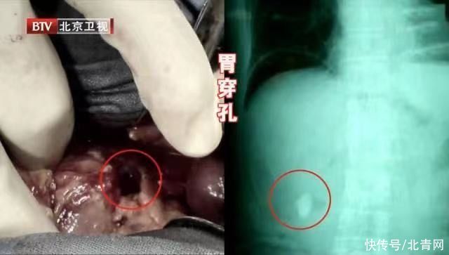 胃食管反流|胃病无小事，一不小心可能拖成癌！有这些迹象要及时就诊