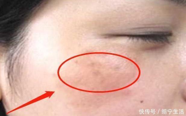 色斑|女性患有妇科炎病脸上多有3大变化,常喝1杯水,抑菌消炎养子宫