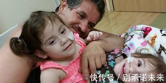 姐妹花 这对连体姐妹花,手术成功分离,每人拥有一条腿,未来的路很艰难