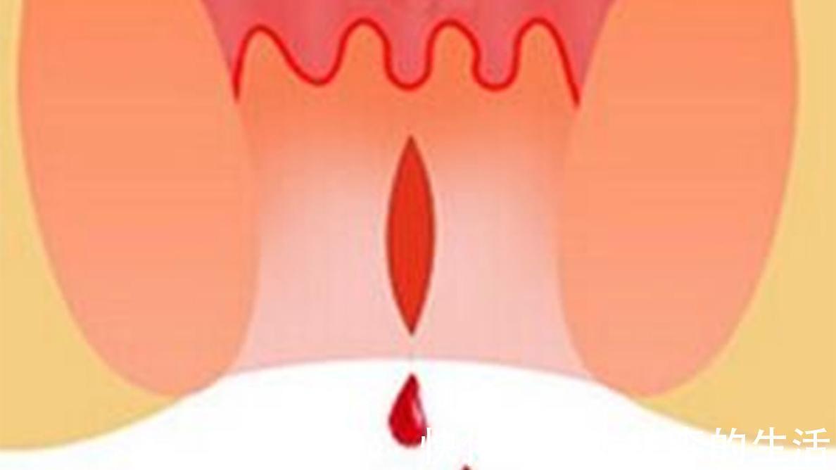 外痔|痔疮出血不是小事,这个事实你应该知道!