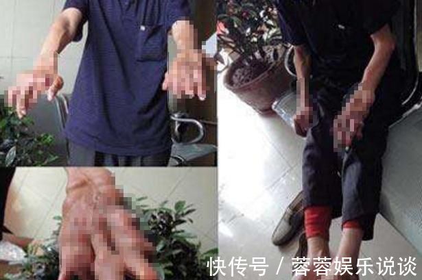 栀子苷|痛风尿酸不降，关节组织被“侵蚀”，5种植物泡水喝，尿酸悄悄走