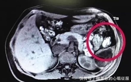 超声检查|做了多次B超检查还是没发现胎儿,医生详细检查后,不由大吃一惊