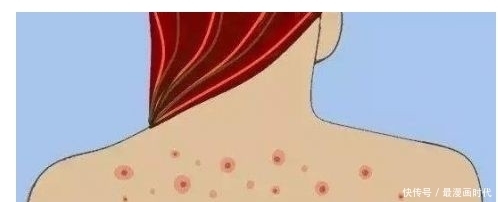 后背老长痘,是因为没洗干净?可能你忽略了这一点