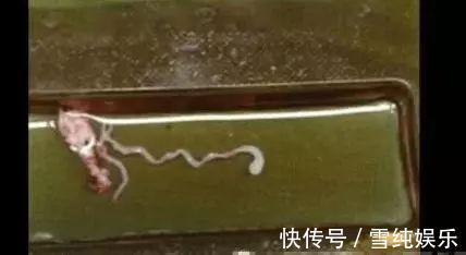 豪豪|7岁小男孩,脑中发现8厘米长虫,医生孩子妈太无知,害了孩子