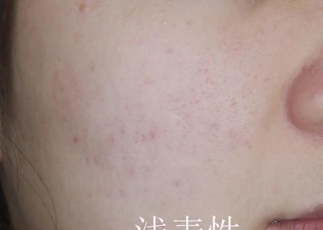 “痘坑”怎样修复,能否选择‘’无恢复期‘’的治疗项目