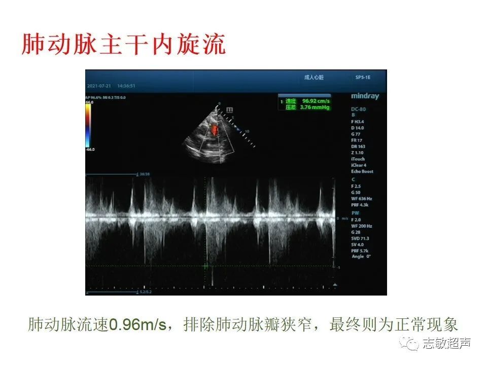 超声|肺动脉瓣周边异常血流的超声鉴别