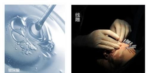 脸上有法令纹，填充玻尿酸还是做线雕？听听医生怎么说