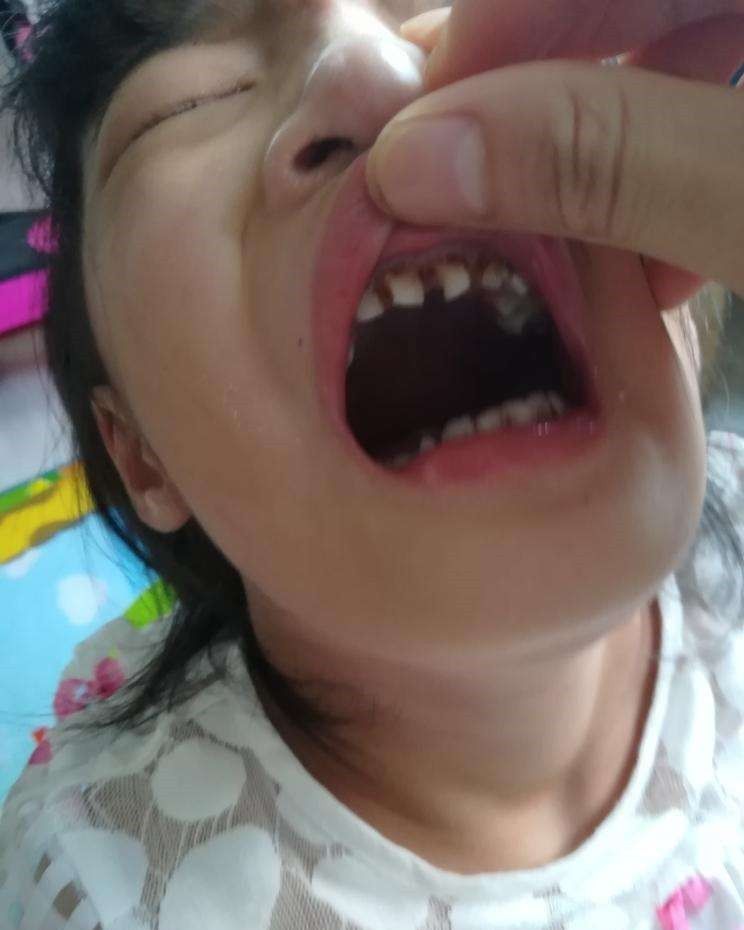 维生素b1|女孩小小年纪就近视1500度，原来和吃的食物有关，家长要警惕