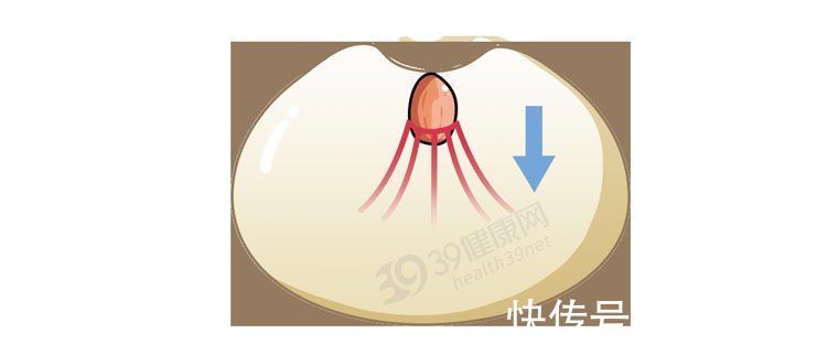 乳房|什么是“乳头内陷”？要怎么治疗？2个原因，可能让它暂时消失