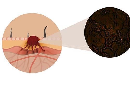 肿瘤|为何部分癌症患者，肿瘤没有切除却活很久？原来与6个因素有关